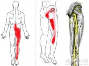坐骨神经痛能治好吗