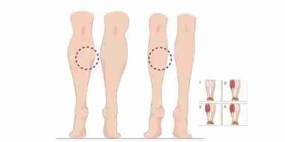 走路时小腿肚子疼，什么原因造成的。有什么方法可以医治(走路小腿肚子疼怎么缓解)