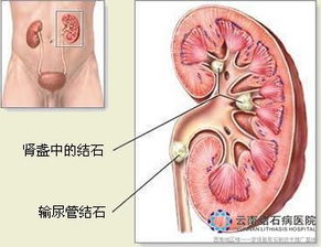 肾结石用激光打好吗(肾结石用激光打是怎样打的)