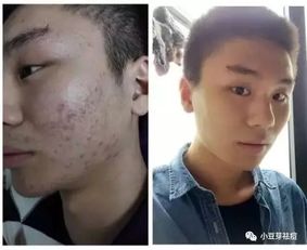 男生女生都爱长痘痘,为什么男生长痘会特别严重 