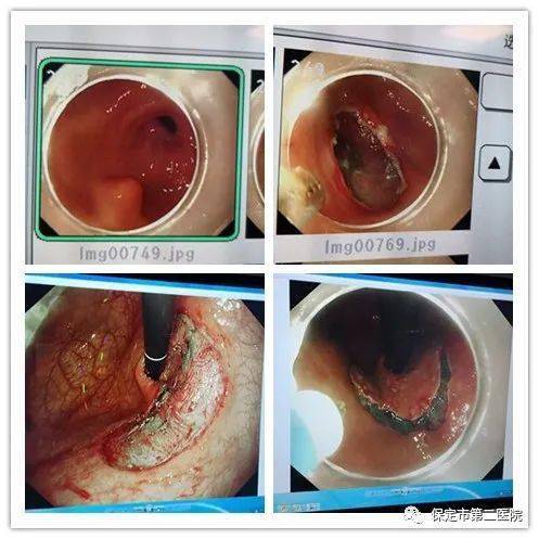不开刀 切除胃肠道肿瘤
