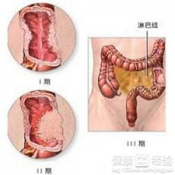 慢性结肠炎症状出血吗