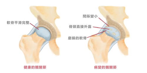 引起髋关节疼痛的病因有哪些？