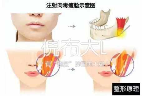 倪布 瘦脸针3次定型,永久保持就这么简单 