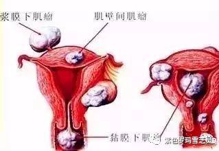 为什么子宫肌瘤切掉了肝上又长囊肿