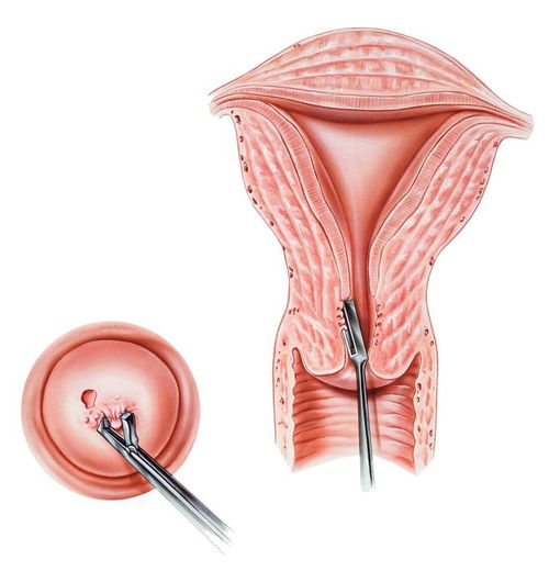 派特灵派特生物科普 宫颈癌筛查tct和hpv有什么区别