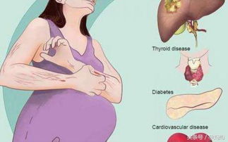 妊娠合并肝内胆汁淤积症，什么是妊娠期肝内胆汁淤积症