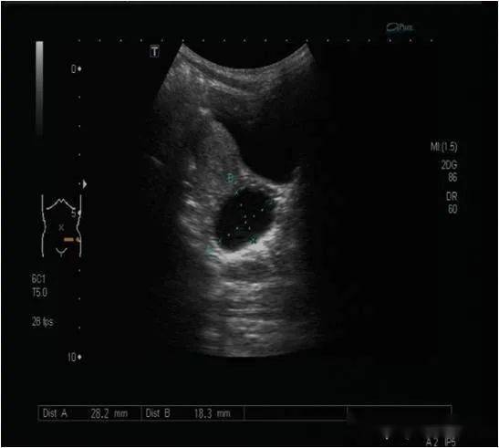 请问B超单上显示宫腔内探及一个囊性回声大小为1.5*1.4cm，这个是孕囊么？