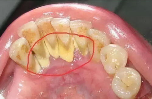 牙结石 可以自己抠掉吗 教你一招,牙缝的脏东西或能轻松掉