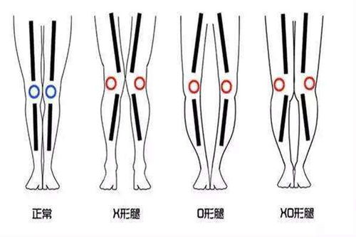 罗圈腿遗传吗 罗圈腿是遗传吗可以改善吗