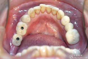 种植牙牙龈乳头诱导成型