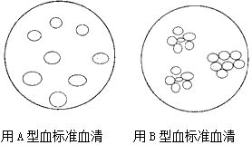 若取某人的血清分别与四种不同血型的血液混合,有三种都发生了凝血现象,则可判断此人血型是 