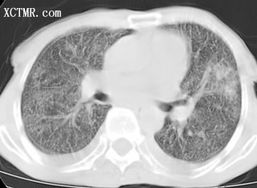 肺部真菌感染 Pulmonary fungal infection CT病例