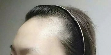 中国约2亿男女被脱发秃顶 发际线后退等困扰,有你吗 附免费脱发拯救计划