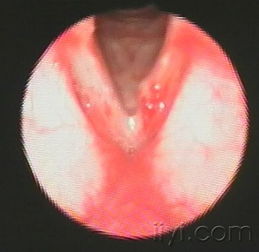 纤维镜图片2 耳鼻咽喉 头颈外科专业版 爱爱医医学论坛 