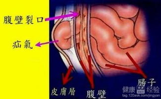 疝气手术复发率高吗