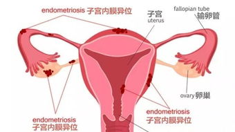 困扰全世界1 10女性的疾病,确诊它却花了10年