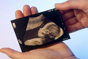 四维男女宝宝区别图 教你利用彩超数据看胎儿性别 3