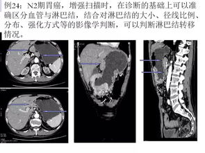 CT增强检查的临床意义 