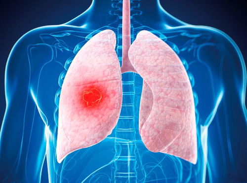 肺癌晚期都是 拖 出来的,3种咳嗽要重视,早做检查会更好