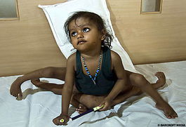 印度8肢女童成功进行肢体分离手术 