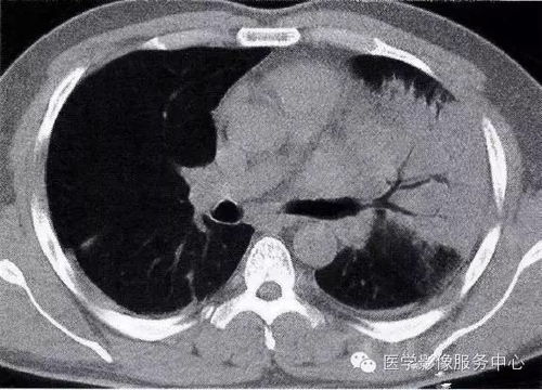 肺部炎症的 七大 常见CT表现