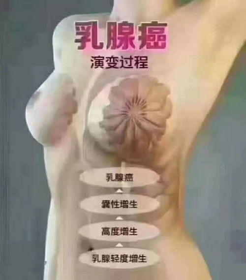 乳腺增生是怎么回事？要紧吗？，乳腺增生要紧吗