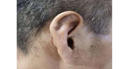耳廓假性囊肿是什么 有危险吗