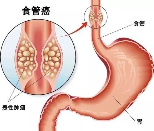 食道癌的早期信号是什么 食道癌的高危人群有哪些