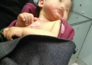 男婴被100 水烫伤 妈妈的急救医生都点赞 这些急救措施请收好 