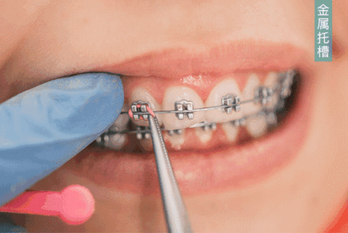 为什么宝安医生劝你做牙齿矫正 有烤瓷牙 种植牙能做矫正吗