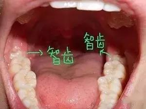 临沂备孕的女性到底要不要拔智齿