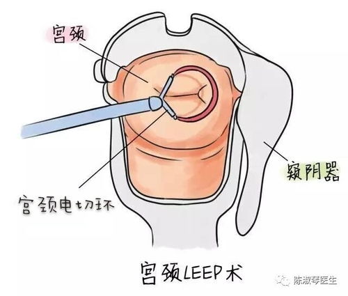 宫颈锥切到底是怎么一回事