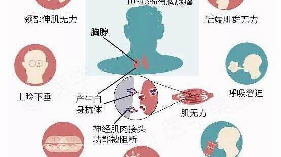 北京重症肌无力科殷世荣 重症肌无力的康复锻炼有哪些 应该怎么办