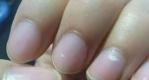 指甲长竖纹 白斑 黑线是疾病征兆 这些实情,现在知道还不晚