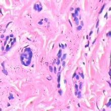 警惕！非鳞状上皮细胞高1.76，是癌症前兆还是健康隐患？