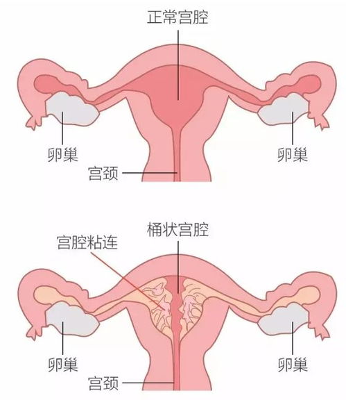 重度宫腔粘连一定 孕 气不佳 那是你没遇到对的人