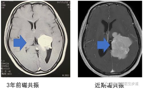 良性脑膜瘤生长快吗