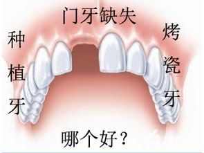 福州门牙断了做种植牙好不好 做烤瓷牙怎么样