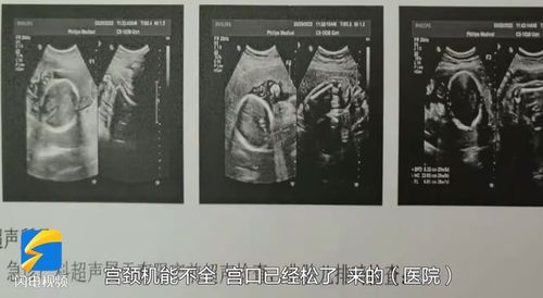 山东一孕妇身怀四胞胎生产不同天(这一情况有多罕见)