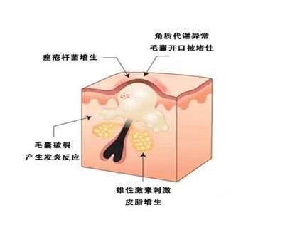 痤疮的发生主要有哪些原因 生痤疮的原因是什么