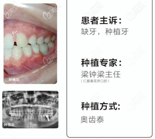  德国种植体icx怎么样,种植牙哪个品牌好 钱包应用