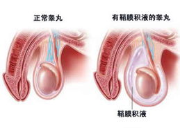 睾丸鞘膜积液影响生育吗 