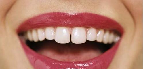 很多牙缝中有轻度龋齿，医生说补的话钻得比烂的多，该怎么办呢