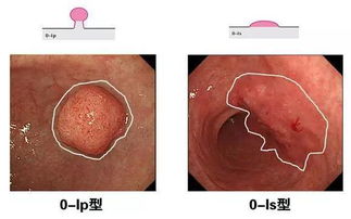 如何在胃镜下发现早期胃癌 