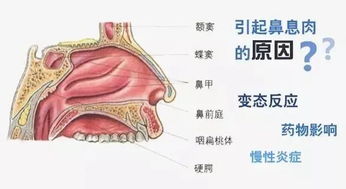 有鼻炎就有鼻息肉吗 为什么鼻息肉术后容易复发,如何防治