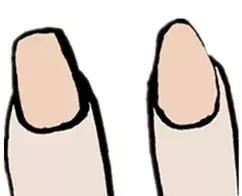 过度修剪指甲怎么办？专家教你如何恢复健康指甲