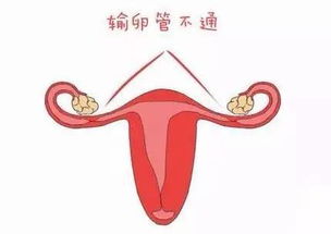 兰州天伦生育科普：输卵管上举是什么原因造成的？会影响女性生育吗？