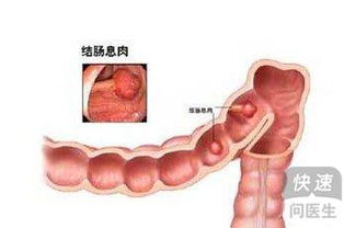 结肠息肉的症状 仔细观察症状变化