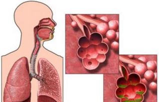 慢性阻塞性肺疾病发生气流性阻塞的主要原因